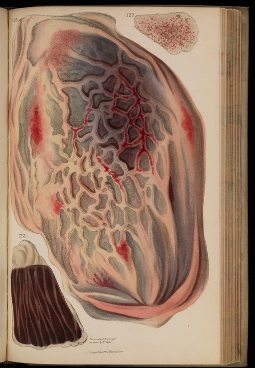 Figures 121-123. Dissection of tubercular lungs.