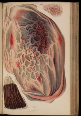 Principles and illustrations of morbid anatomy; adapted to the elements of M. Andral, and to the Cyclopaedia of practical medicine ... / being a complete series of coloured lithographic drawings from originals by the author; with descriptions and summary allusions to cases, symptoms, treatment, &c. ... By J. Hope.