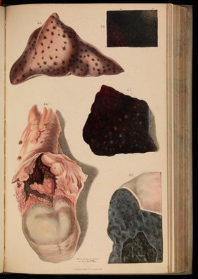 Principles and illustrations of morbid anatomy; adapted to the elements of M. Andral, and to the Cyclopaedia of practical medicine ... / being a complete series of coloured lithographic drawings from originals by the author; with descriptions and summary allusions to cases, symptoms, treatment, &c. ... By J. Hope.