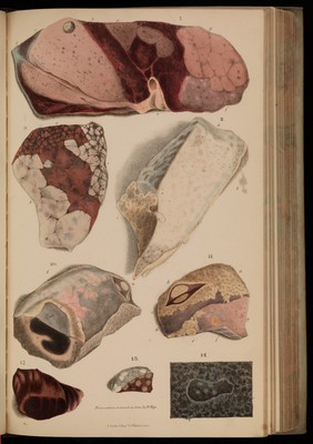 Principles and illustrations of morbid anatomy; adapted to the elements of M. Andral, and to the Cyclopaedia of practical medicine ... / being a complete series of coloured lithographic drawings from originals by the author; with descriptions and summary allusions to cases, symptoms, treatment, &c. ... By J. Hope.