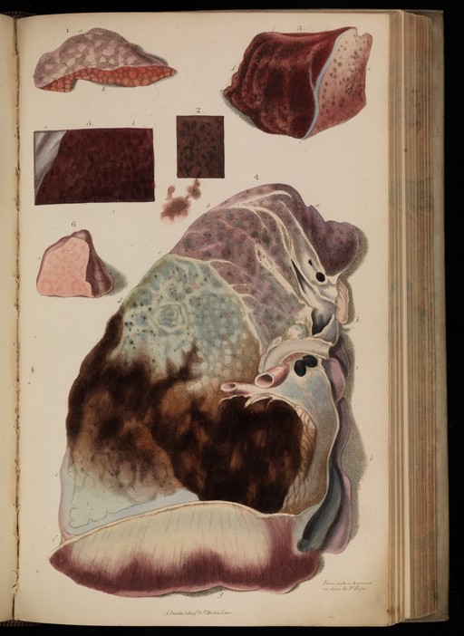 Figures 1-6. Dissection of tubercular lungs.