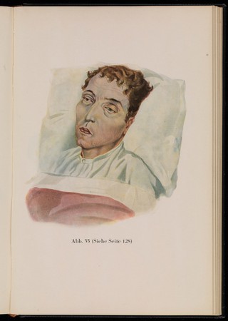 Kranken-Physiognomik / von K. H. Baumgärtner.