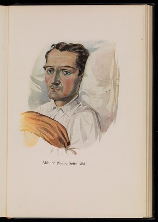 Kranken-Physiognomik / von K. H. Baumgärtner.