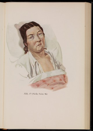 Kranken-Physiognomik / von K. H. Baumgärtner.