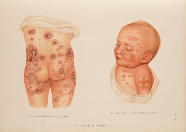 Atlas of the diseases of the skin / by H. Radcliffe Crocker.