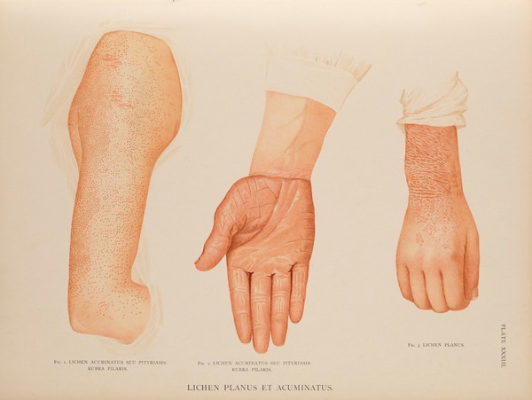 Atlas of the diseases of the skin / by H. Radcliffe Crocker.