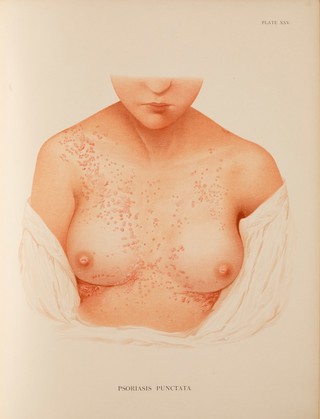 Atlas of the diseases of the skin / by H. Radcliffe Crocker.