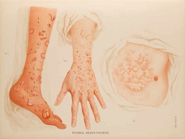 Atlas of the diseases of the skin / by H. Radcliffe Crocker.
