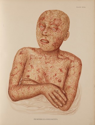Atlas of the diseases of the skin / by H. Radcliffe Crocker.