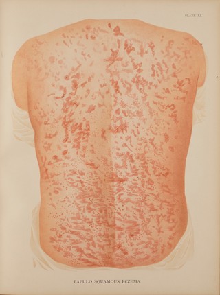 Atlas of the diseases of the skin / by H. Radcliffe Crocker.