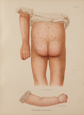 Atlas of the diseases of the skin / by H. Radcliffe Crocker.