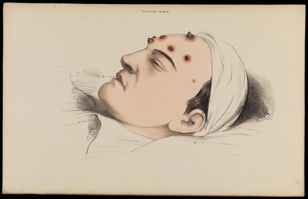 Illustrations of cutaneous disease : a series of delineations of the affections of the skin in their more interesting and frequent forms; with a practical summary of their symptoms, diagnosis, and treatment, including appropriate formulae / by Robert Willis ; the drawings after nature, and lithographed by Arch. Henning.