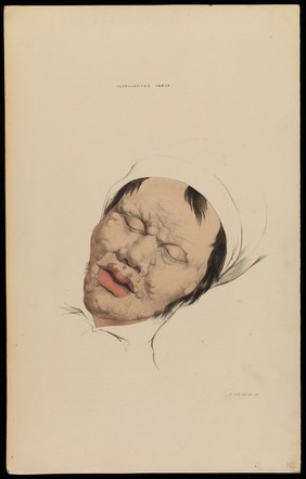 Illustrations of cutaneous disease : a series of delineations of the affections of the skin in their more interesting and frequent forms; with a practical summary of their symptoms, diagnosis, and treatment, including appropriate formulae / by Robert Willis ; the drawings after nature, and lithographed by Arch. Henning.