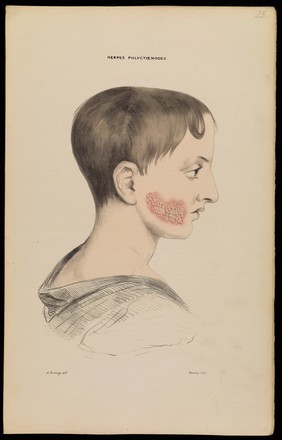 Illustrations of cutaneous disease : a series of delineations of the affections of the skin in their more interesting and frequent forms; with a practical summary of their symptoms, diagnosis, and treatment, including appropriate formulae / by Robert Willis ; the drawings after nature, and lithographed by Arch. Henning.