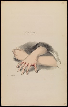 Illustrations of cutaneous disease : a series of delineations of the affections of the skin in their more interesting and frequent forms; with a practical summary of their symptoms, diagnosis, and treatment, including appropriate formulae / by Robert Willis ; the drawings after nature, and lithographed by Arch. Henning.
