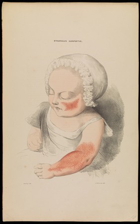 Illustrations of cutaneous disease : a series of delineations of the affections of the skin in their more interesting and frequent forms; with a practical summary of their symptoms, diagnosis, and treatment, including appropriate formulae / by Robert Willis ; the drawings after nature, and lithographed by Arch. Henning.