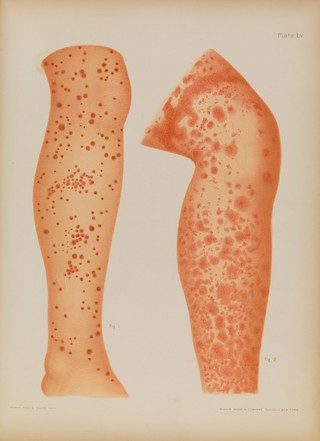 Atlas of skin and venereal diseases / comprising original illustrations and selections from the plates of M. Kaposi [and others] ; with original text by Prince A. Morrow.