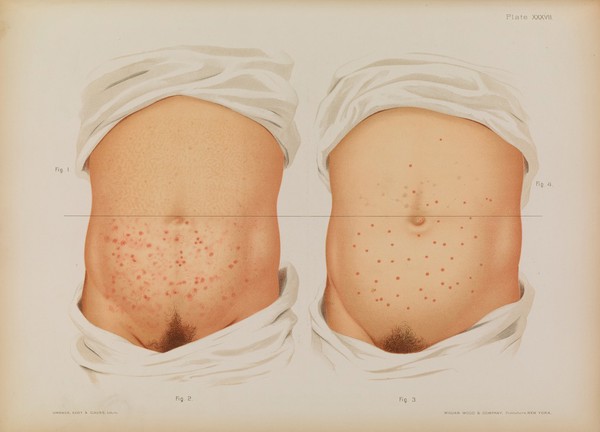 Atlas of skin and venereal diseases / comprising original illustrations and selections from the plates of M. Kaposi [and others] ; with original text by Prince A. Morrow.