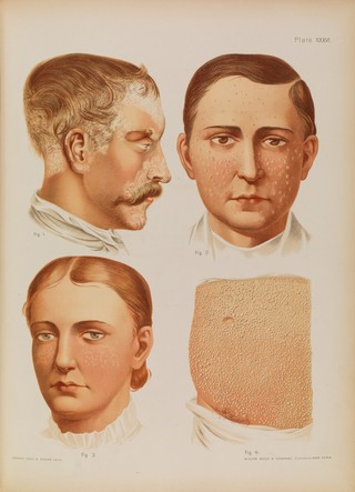 Atlas of skin and venereal diseases / comprising original illustrations and selections from the plates of M. Kaposi [and others] ; with original text by Prince A. Morrow.