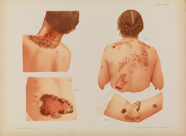 Atlas of skin and venereal diseases / comprising original illustrations and selections from the plates of M. Kaposi [and others] ; with original text by Prince A. Morrow.