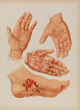 Atlas of skin and venereal diseases / comprising original illustrations and selections from the plates of M. Kaposi [and others] ; with original text by Prince A. Morrow.