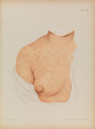 Atlas of skin and venereal diseases / comprising original illustrations and selections from the plates of M. Kaposi [and others] ; with original text by Prince A. Morrow.