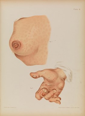 Atlas of skin and venereal diseases / comprising original illustrations and selections from the plates of M. Kaposi [and others] ; with original text by Prince A. Morrow.