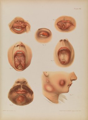 Atlas of skin and venereal diseases / comprising original illustrations and selections from the plates of M. Kaposi [and others] ; with original text by Prince A. Morrow.