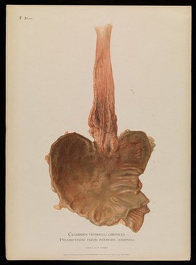 Illustrations of pathological anatomy : being a series of chromographed plates painted from nature immediately after death / with descriptive text by Alfred Kast and Theodor Rumpel ; English edition, revised and edited by M. Armand Ruffer.