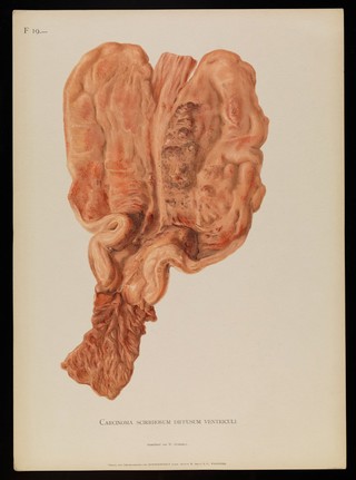 Illustrations of pathological anatomy : being a series of chromographed plates painted from nature immediately after death / with descriptive text by Alfred Kast and Theodor Rumpel ; English edition, revised and edited by M. Armand Ruffer.