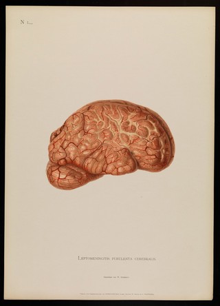 Illustrations of pathological anatomy : being a series of chromographed plates painted from nature immediately after death / with descriptive text by Alfred Kast and Theodor Rumpel ; English edition, revised and edited by M. Armand Ruffer.