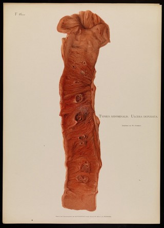 Illustrations of pathological anatomy : being a series of chromographed plates painted from nature immediately after death / with descriptive text by Alfred Kast and Theodor Rumpel ; English edition, revised and edited by M. Armand Ruffer.
