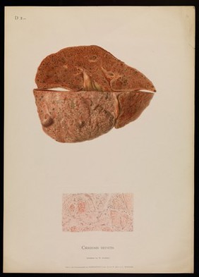 Illustrations of pathological anatomy : being a series of chromographed plates painted from nature immediately after death / with descriptive text by Alfred Kast and Theodor Rumpel ; English edition, revised and edited by M. Armand Ruffer.