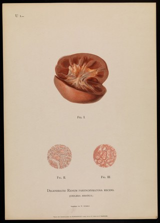 Illustrations of pathological anatomy : being a series of chromographed plates painted from nature immediately after death / with descriptive text by Alfred Kast and Theodor Rumpel ; English edition, revised and edited by M. Armand Ruffer.