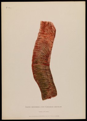 Illustrations of pathological anatomy : being a series of chromographed plates painted from nature immediately after death / with descriptive text by Alfred Kast and Theodor Rumpel ; English edition, revised and edited by M. Armand Ruffer.