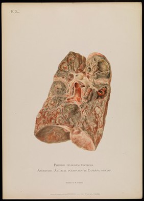 Illustrations of pathological anatomy : being a series of chromographed plates painted from nature immediately after death / with descriptive text by Alfred Kast and Theodor Rumpel ; English edition, revised and edited by M. Armand Ruffer.