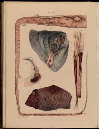 Pathological anatomy : illustrations of the elementary forms of disease / By Robert Carswell.