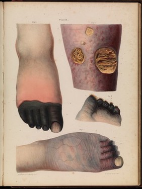 Pathological anatomy : illustrations of the elementary forms of disease / By Robert Carswell.