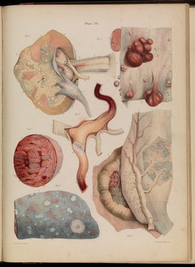 Pathological anatomy : illustrations of the elementary forms of disease / By Robert Carswell.