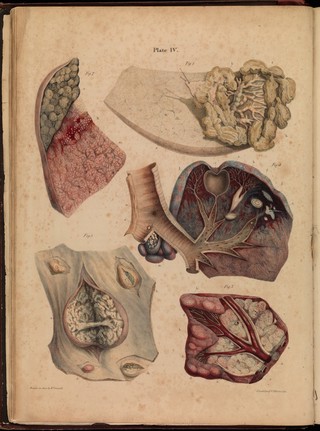 Pathological anatomy : illustrations of the elementary forms of disease / By Robert Carswell.