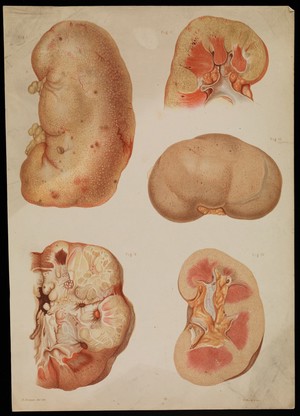 view Diseased kidneys: five examples. Chromolithograph by E. Burgess, 1877/1899?.