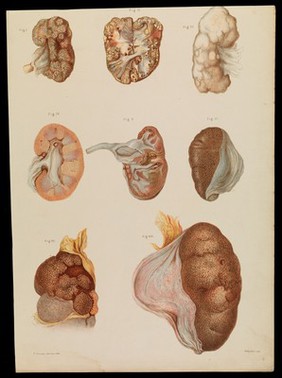 Diseased organs (kidneys?): eight examples. Chromolithograph by E. Burgess, 1877/1899?.