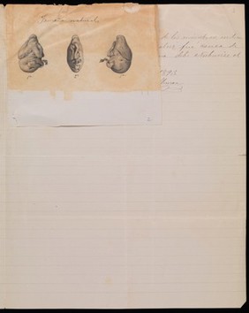 Un feto - a handwritten case study of an teratological case