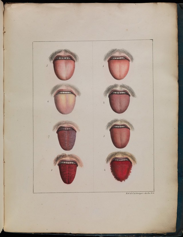 Different stages of yellow fever, 1820 Collection