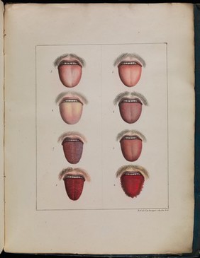 Observations sur la fièvre jaune, faites à Cadix, en 1819 / par MM. Pariset et Mazet ... et rédigées par M. Pariset.