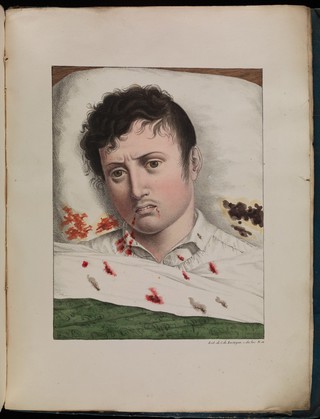 Observations sur la fièvre jaune, faites à Cadix, en 1819 / par MM. Pariset et Mazet ... et rédigées par M. Pariset.