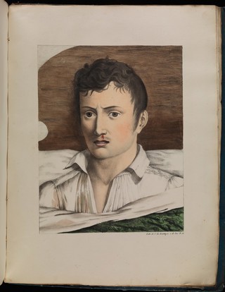 Observations sur la fièvre jaune, faites à Cadix, en 1819 / par MM. Pariset et Mazet ... et rédigées par M. Pariset.