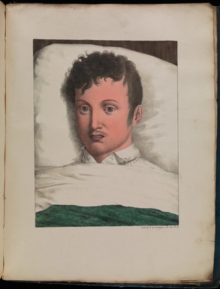 Observations sur la fièvre jaune, faites à Cadix, en 1819 / par MM. Pariset et Mazet ... et rédigées par M. Pariset.