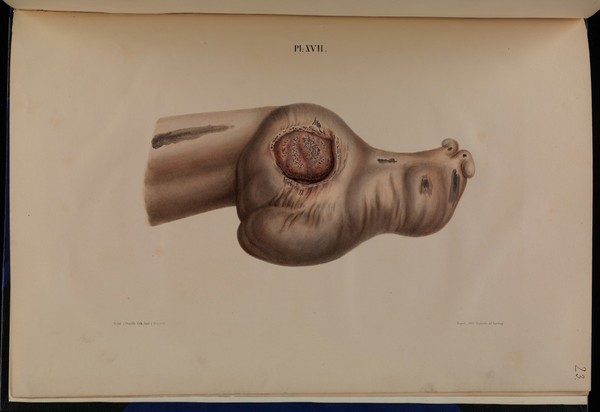 Om spedalskhed ... Atlas / udgivet efter foranstaltning of den Kongelige Norske Regjerings Department for det Indre. Tegningerne udförte af J.L. Losting.