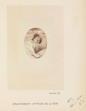 Iconographie photographique de la Salpêtrière : service de M. Charcot / par Bourneville et P. Regnard.